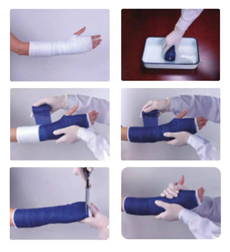 Étapes d'utilisation du ruban de moulage orthopédique